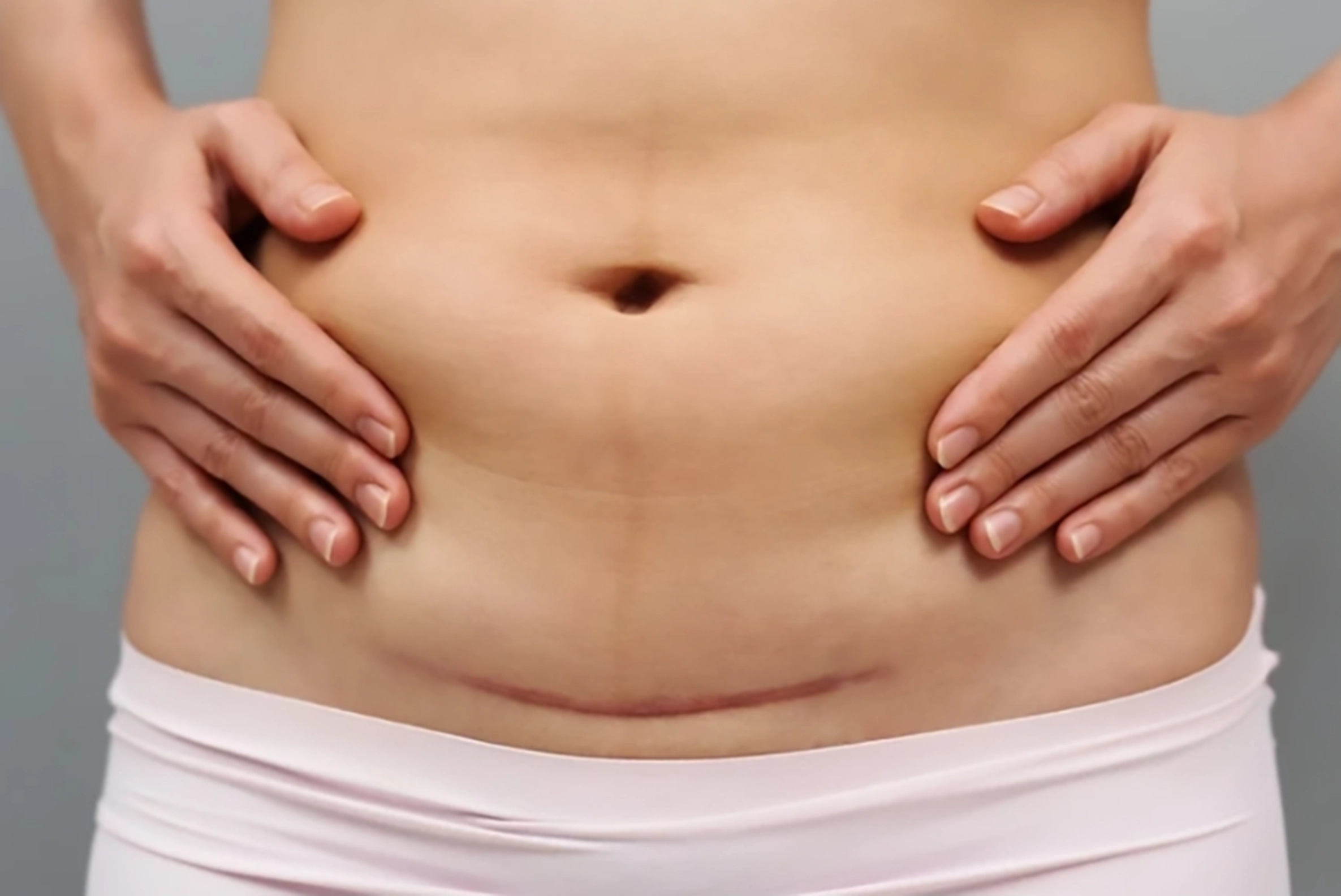 An image C-section scar, one of the scar therapy Welch Scar Therapy provides.