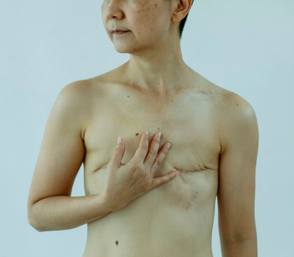 a person presenting scars on the breast area.