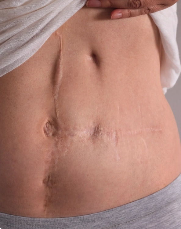 person showing post-operation surgery scars on belly