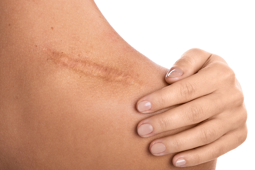 Scar on shoulder, a type of scar that Welch Scar Therapy provides support for.